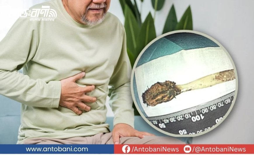 চীনে বৃদ্ধের পেট থেকে বের হলো ৫২ বছর আগের টুথব্রাশ!